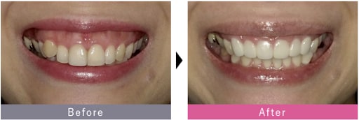 かがいこうごう　症例写真前後